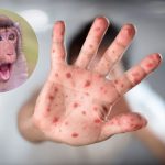 La viruela del mono: Autoridades de la Salud investigan varios casos en Reino Unido, España, Portugal y EE.UU. ¿De qué se trata esta enfermedad?
